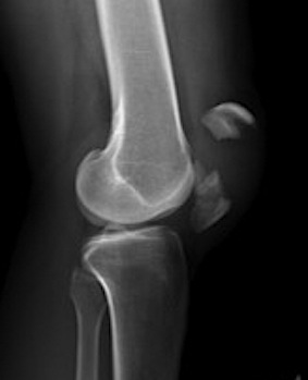 Patella Fracture Displaced